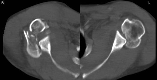 CT of both sides confirming the dislocation.