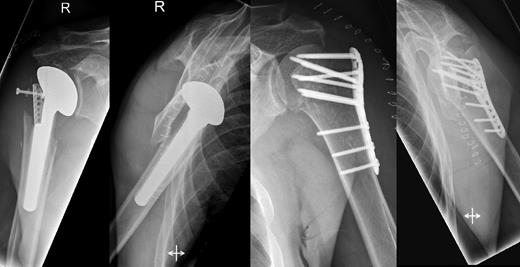 Postoperative X-rays after hemiprothetic replacement on the right and angle stable plate osteosynthesis on the left side.