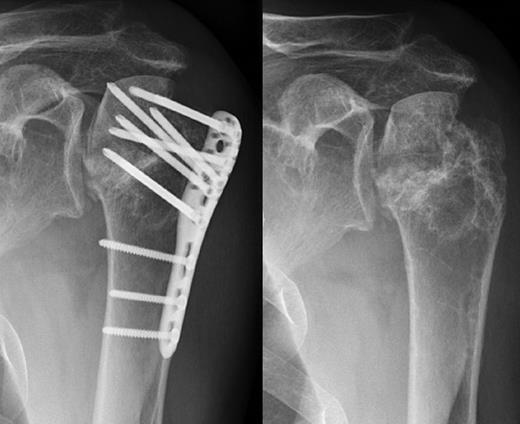 Avascular head necrosis over the following one and a half years on the left side with ongoing necrosis after plate removal.