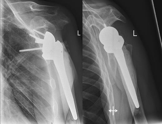 Inversed prothetic replacement of the left side.