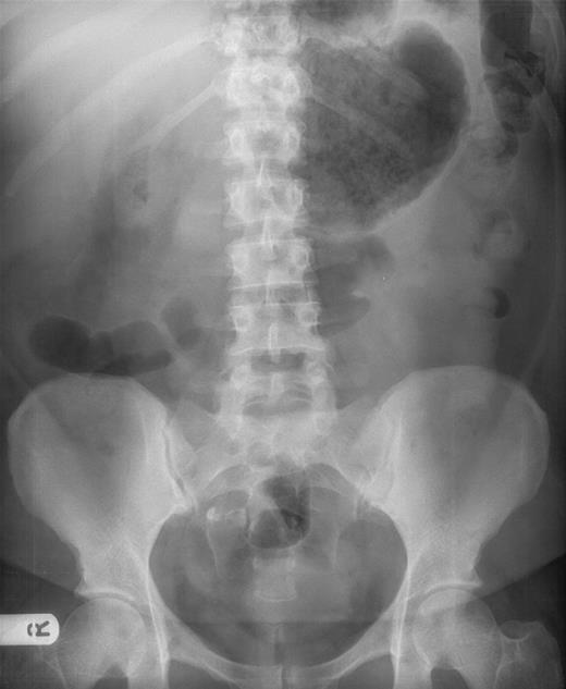 Abdominal X-ray showing dilated viscus in the right upper quadrant, initially reported as large distended stomach, in retrospect thought to be the caecum.