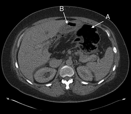 Axial section through upper abdomen showing (A) distended caecum and (B) behind the stomach.