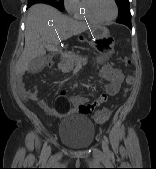 Coronal section showing part of the colon passing behind the portal vessels (C) and a distended caecum in the lesser sac (D).