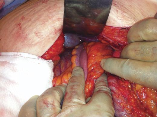 Terminal illeum disappearing behind the portal vessels, inferior to the gallbladder and into the lesser sac.