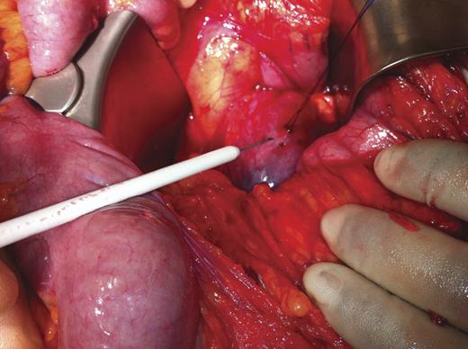 Having opened up the lesser sac, the distended herniated portion of caecum can be seen about to needle decompressed under cover of a purse string suture.