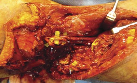 Intraoperative photography reveals gaps of tibial (*), common peroneal (†) and sural (‡) nerves associated with lesions of the gastrocnemic muscles.