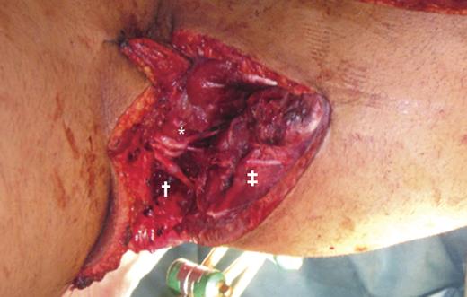 Intraoperative photography after fixation of the knee in 90° flexion and sutures of tibial (*) and common peroneal (†) nerve. Junction of the sural (‡) nerve has not yet been performed.