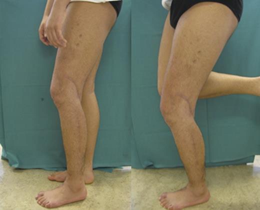 Clinical examination 6 months after trauma showed well-healed wounds and the possibility to stand on the left leg without aid.