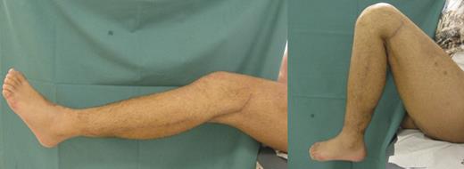 Good range of motion (flexion/extension 140-10-0°) 6 months after trauma.