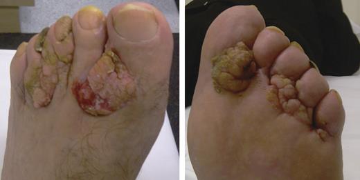 Appearance of the patient's left foot at diagnosis.