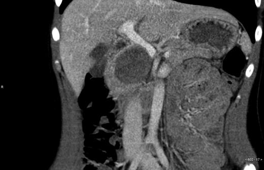 CT, coronal slices.