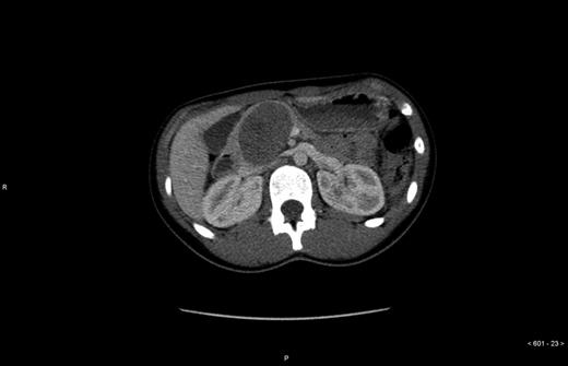 CT, axial slices.