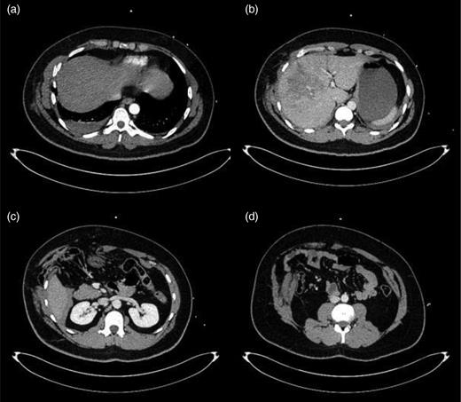 (a–d) Initial CT imaging performed as part of the secondary survey.