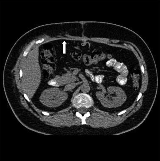 CT at 10 weeks after the injury and primary repair. The mesh is seen in the anterior abdominal wall (arrow).