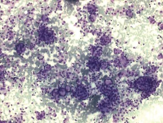 Cytology smear showing cells arranged in loose cohesive clusters with whorling pattern at places. (MGG stain ×100).
