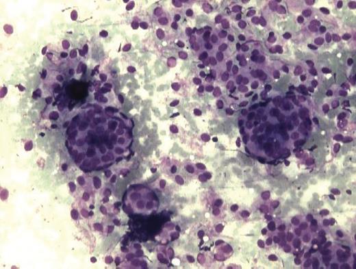 Smear showing occasional psamomma body in between cluster of cells. (MGG ×200).