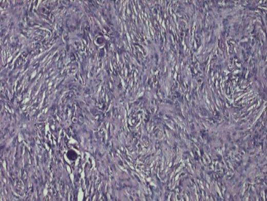 Photomicrograph showing psamomma bodies present in sheets of cells with meningothelial pattern. (Haematoxylin & Eosin stain ×200).
