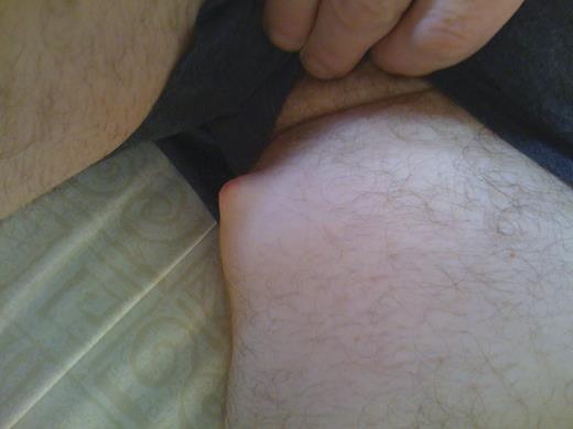 Mass inner aspect left thigh.