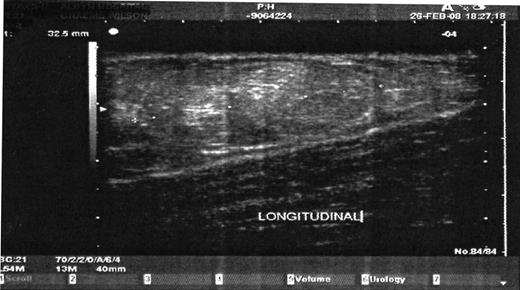 US scan of left thigh lesion.