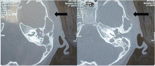 Pre-operative HRCT of left temporal bone. Axial image demonstrates Luc's abscess at left temporal region with soft tissue density and ossicular destruction.
