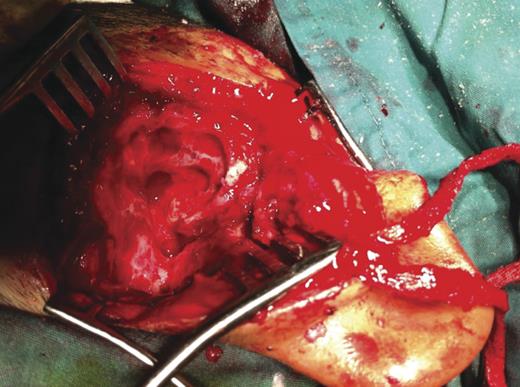 Intra-operative findings in the left mastoid bone.