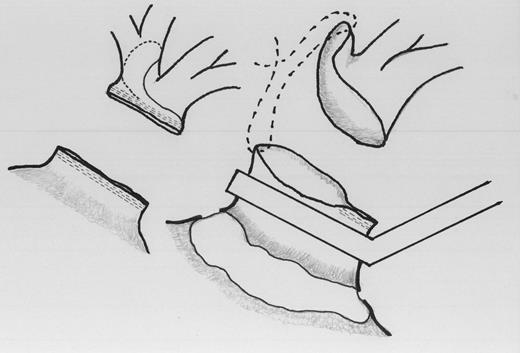 Orifice of an inferior pulmonary vein was augmented with a cuff technique using the orifice of a superior pulmonary vein. The augmented orifice was anastomosed to the common pulmonary vein on the left atrial side after removal of staples as long as necessary under a partial clamp of the left atrium following pericardiotomy.