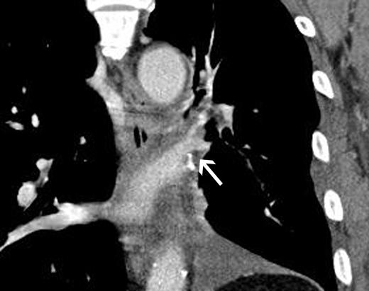Postoperative enhanced CT showing (frontal view) successful reconstruction of an inferior pulmonary vein (arrow).