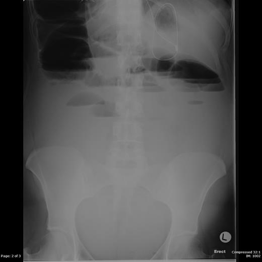 Erect abdominal radiograph showing multiple air-fluid levels.