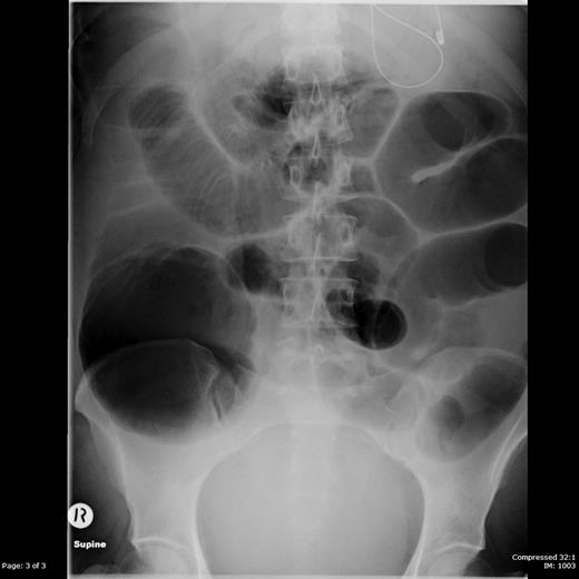 Supine abdominal radiograph showing dilated loops of both large and small bowel.