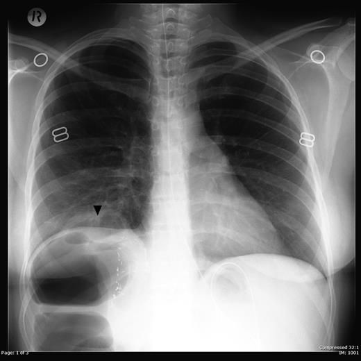 Erect chest radiograph showing a loop of bowel (arrowhead) projecting above the right hemidiaphragm. Clips are seen in the right upper quadrant consistent with previous liver surgery.