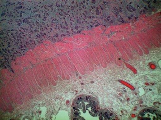 Squamous cell carcinoma metastasis infiltrating peritoneal fat and serosa evident of right hemicolectomy specimen