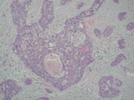 Keratin pearls confirming squamous cell carcinoma metastasis in the tumour specimen