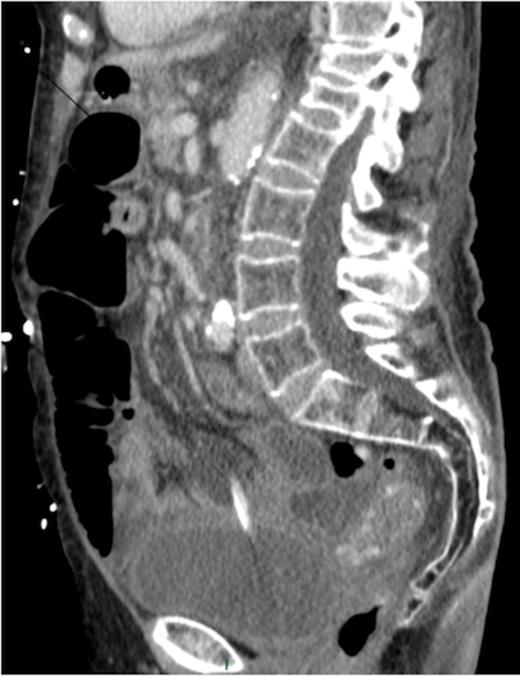 Sagittal CT image showing urethral catheter in the abdominal cavity.