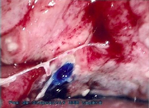Methylene blue dye highlighting the bladder perforation