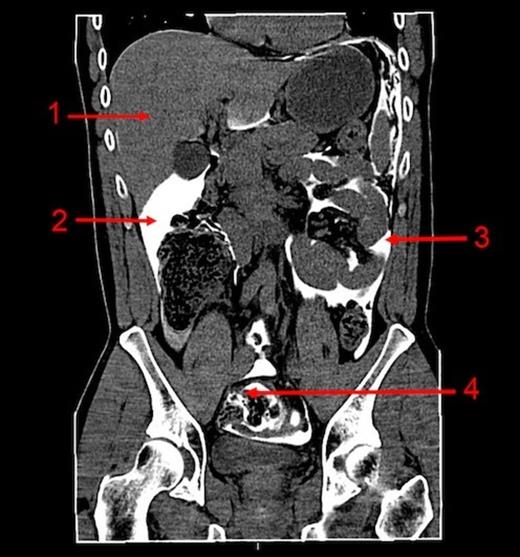 CT abdomen (coronal) with rectal contrast:1. Liver, 2. Contrast in the sub hepatic region, 3. Contrast in the left abdomen, 4. Sigmoid with extra luminal contrast