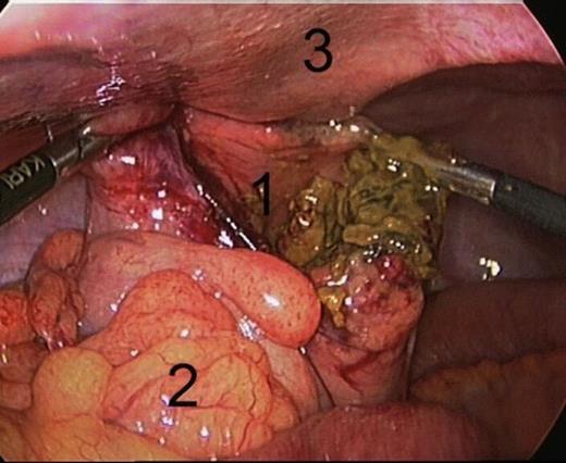 Laparoscopy: defect of the sigmoid:1. Large defect of the Sigmoid, 2. Sigmoid mesocolon, 3. Abdominal wall