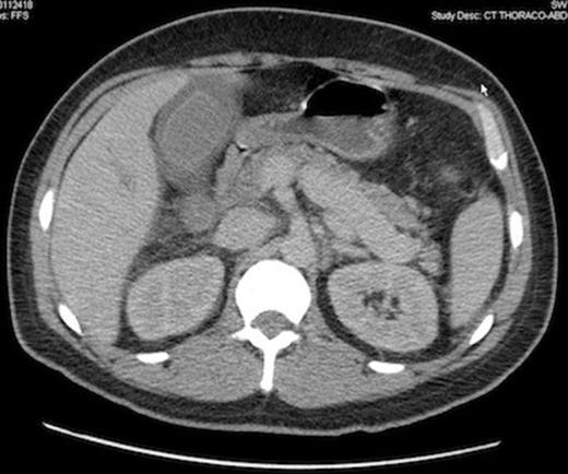 Computed tomography scan demonstrating gallbladder wall thickening and pericholecystic liquid, without gallbladder lithiasis, confirmed by ultrasonography.