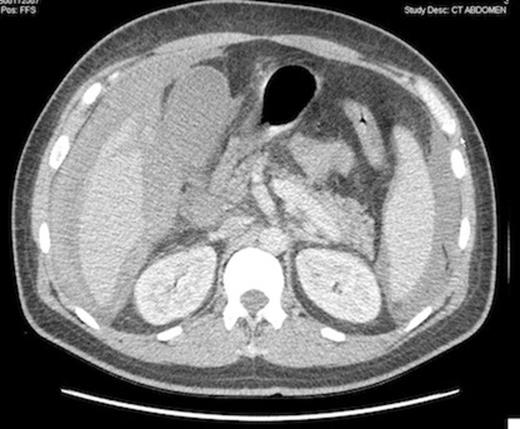 Computed tomography scan showing peritoneal bleeding from hepatic laceration after gallbladder percutaneous transhepatic drainage.