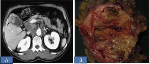 A. CECT Abdomen shows soft tissue density in the region of fundus; B. Cut surface of the resected specimen showing a large variegated tumor in gall bladder