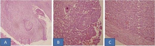 A. H&E stained section shows presence of both malignant epithelial (squamous) and mesenchymal (spindle) components (X100); B. Tumor at higher magnification (X200); C. Mesenchymal (spindle) component of tumor (X100)