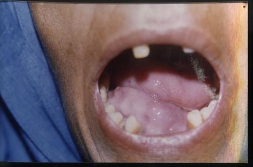 Swelling on surface of tongue