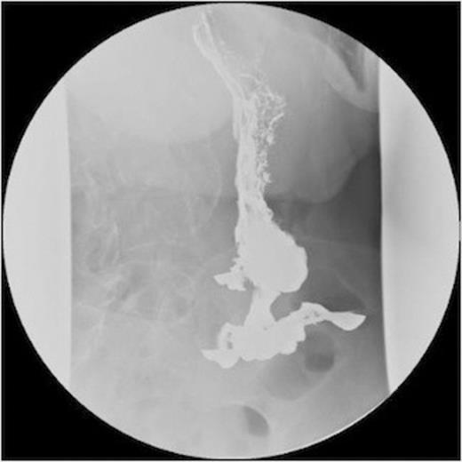 A series of radiographs from barium swallow demonstrating gastro-colic fistula