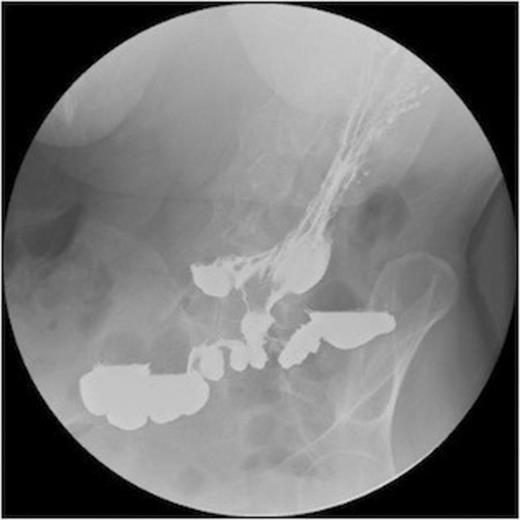 A series of radiographs from barium swallow demonstrating gastro-colic fistula