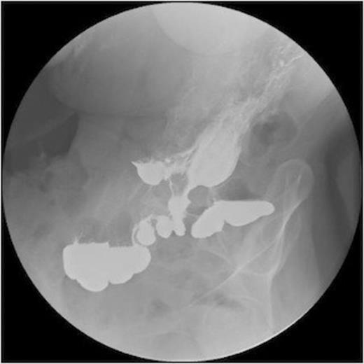 A series of radiographs from barium swallow demonstrating gastro-colic fistula