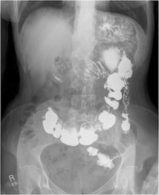 A series of radiographs from barium swallow demonstrating gastro-colic fistula