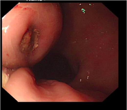 Acute gastric ulcer seen on endoscopy