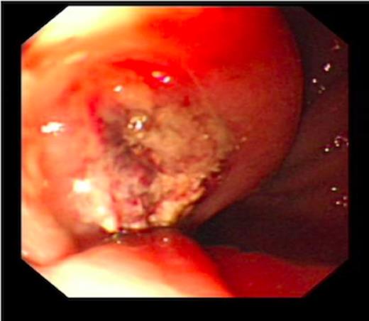 Acute gastric ulcer post treatment with gold probe