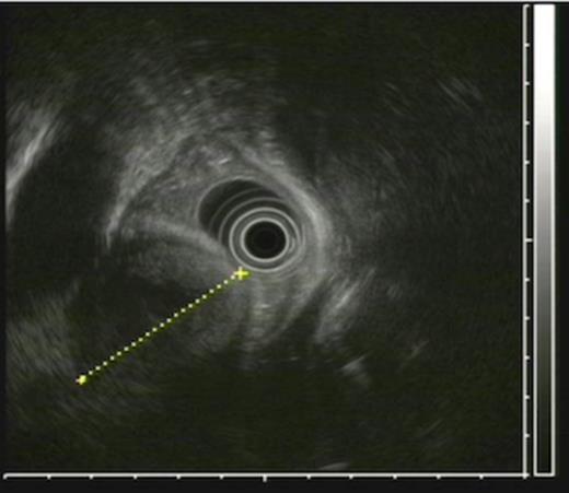 EUS examination showing thoracic aneurysm compressing esophagus