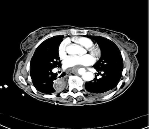 CT scan showing thoracic aortic aneurysm