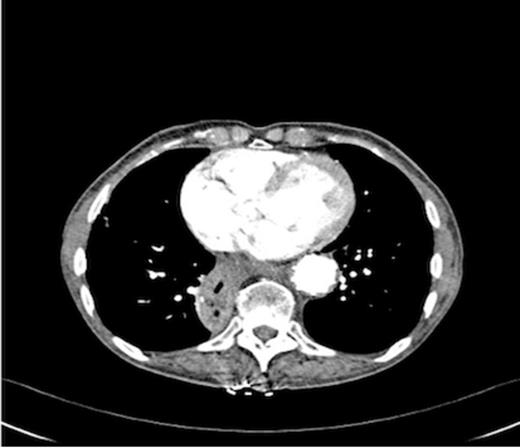 Stent in thoracic aortic aneurysm